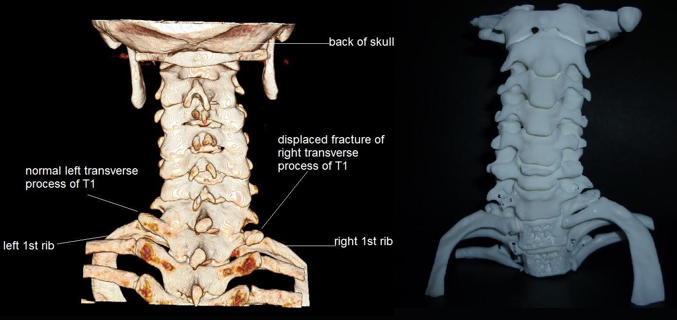 Damaged Spine Only Evident 20 Years After Injury, Thanks to 3D Printing