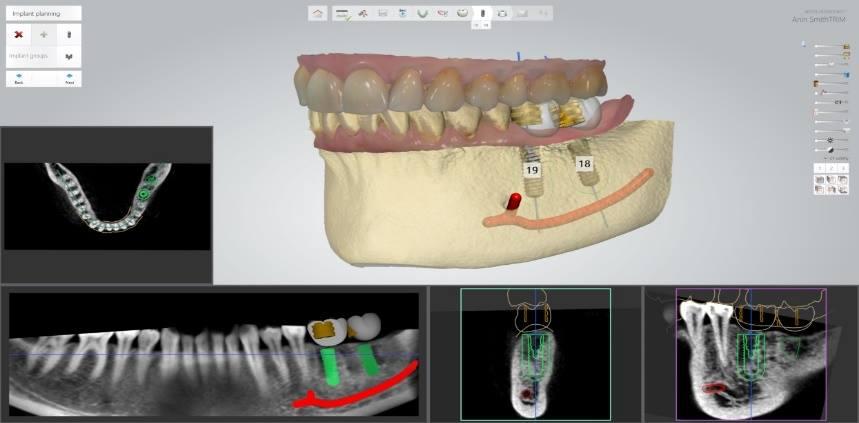 3Shape Teams Up with EnvisionTEC to 3D Print Drill Guides for Dental