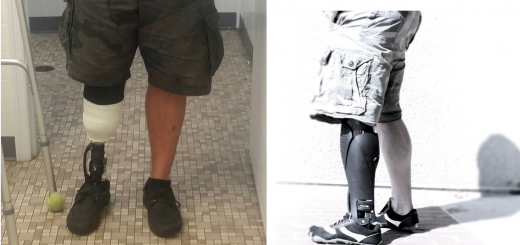 Adam's Leg (left), A Prosthetic Fairing (right)