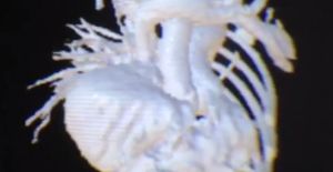 3D image of Teegans heart and chest cavity.