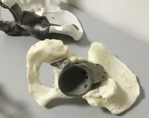 3D printed hip implant.