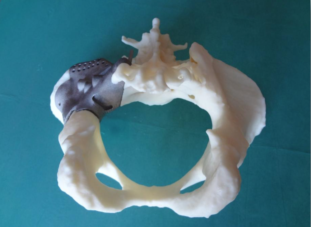Repairing a pelvis injured by cancer with a 3D printed prosthesis.