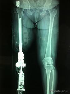 Xray of a surgically implanted prosthetic socket.