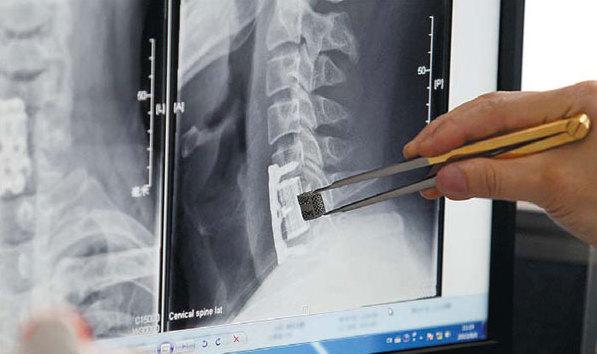 The 3D Printed Implant
