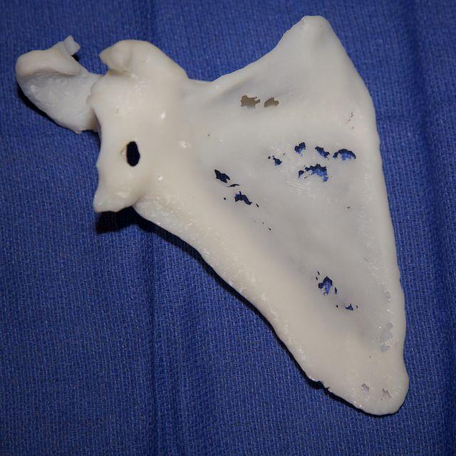 3D Pritned replica of Heth's shoulder (image supplied to 3DPrint.com by Hoag Orthopedic Institute)