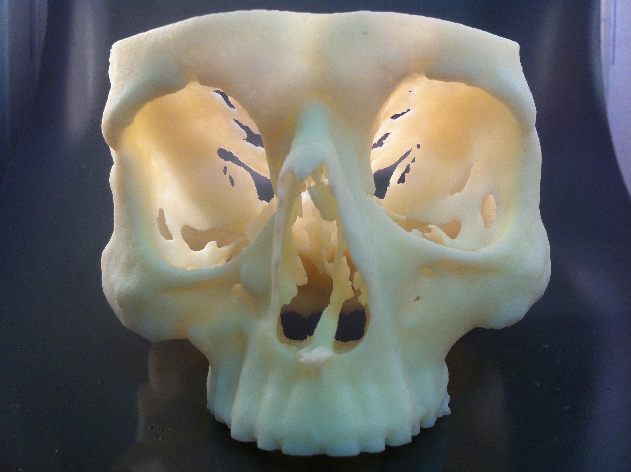 Cranium produced on a Stratasys Objet30 Pro 3D Printer, used to validate patient surgery prior to the operation