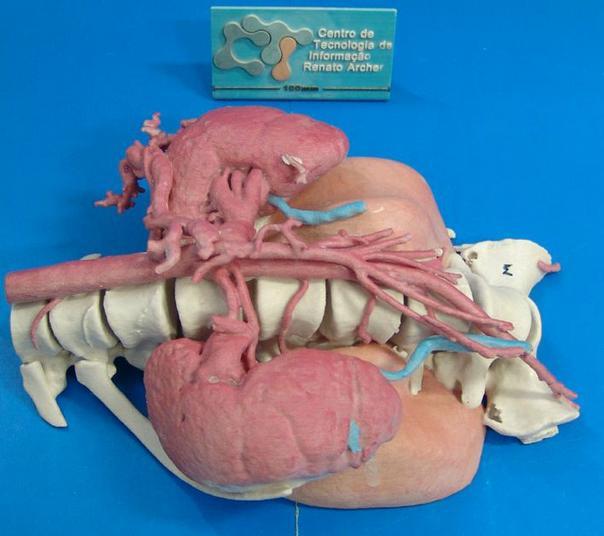 3D printed model of tumor, kidneys, arteries & more.