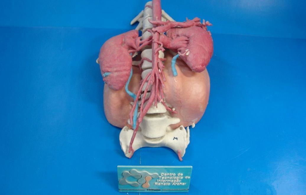 3D printed model that aided surgeons in 12-year-old girl's tumor and vertebrae removal.