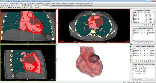 Scan of Bradley's heart and tumor.