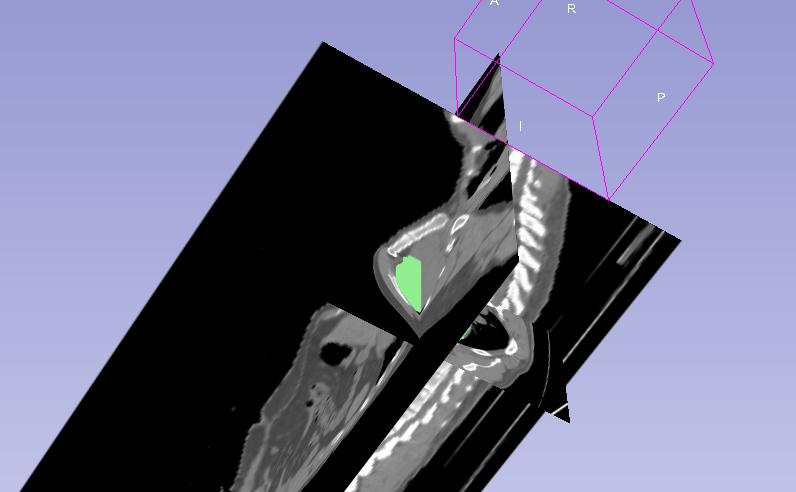 Mark imported the DICOM files from my CT into Slicer, and created a digital model of the tumor by tracing around each slice of the CT