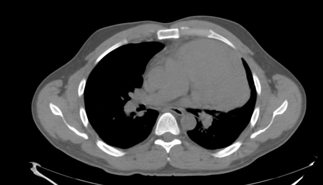 Image showing Mark's tumor collapsing part of his lung.