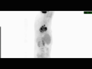 PET/CT of Mark's Tumor (depicted in black).