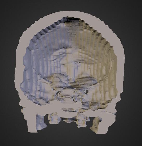 Scan of Shavaun's Skull / Tumor