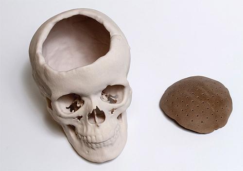 OPM develops polymer laser-sintered OsteoFab Patient-Specific Cranial Devices (OPSCD), which are customizable implants.