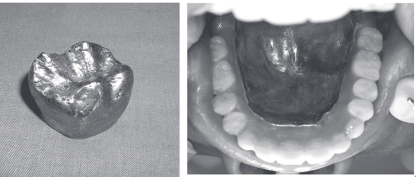 Mandible base plate and titanium crown, fabricated with LSF