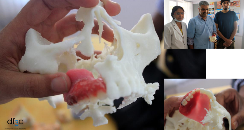 Shown are the 3D printed upper and lower jaws used to create the impression for the prosthetic