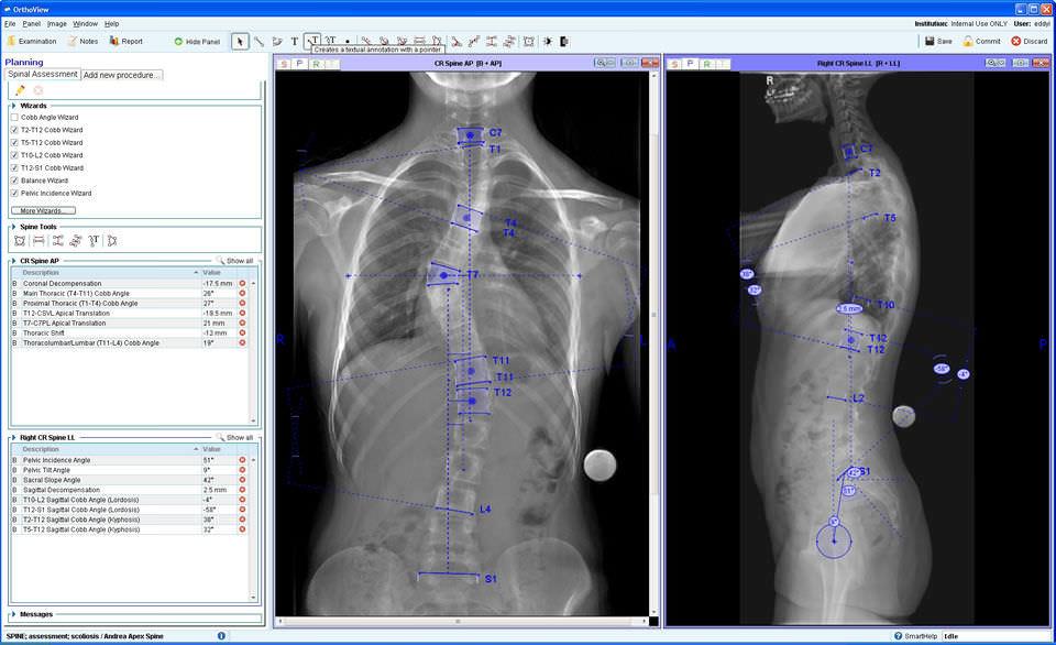 Orthoview Preoperative Planning Software