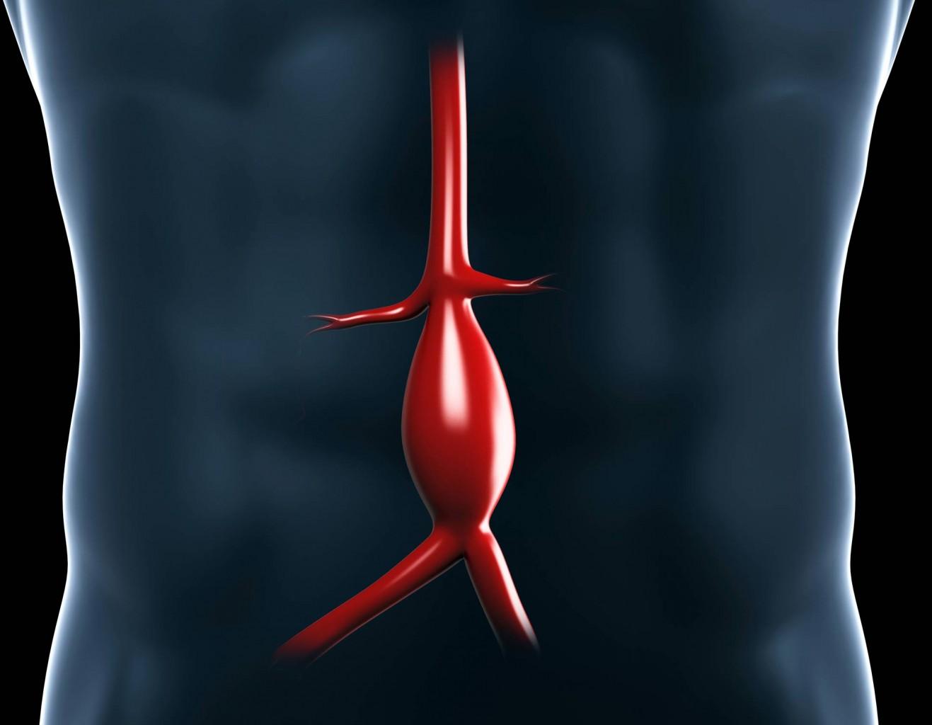 Aortica Corporation Creates 3DPrinted Alternative to Surgery for Abdominal Aortic Aneurysms 