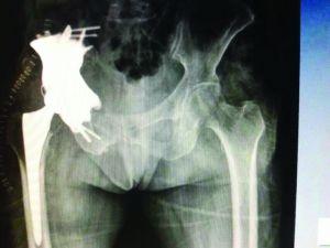 Chinese Doctors 3D Print a Titanium Pelvic Prosthesis for Cancer ...