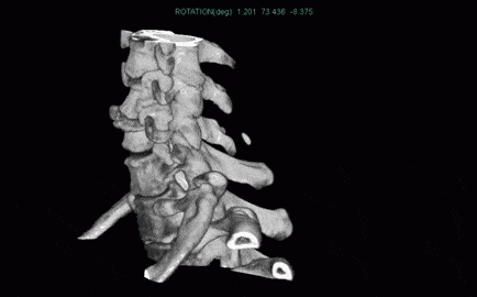 spine cervical 3dprint