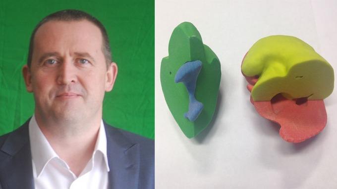 Jim Cousins and his 3D printed kidney