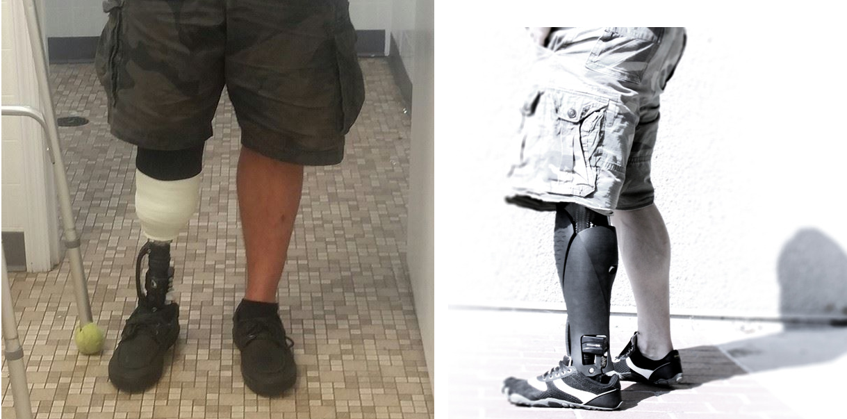 Adam's Leg (left), A Prosthetic Fairing (right)