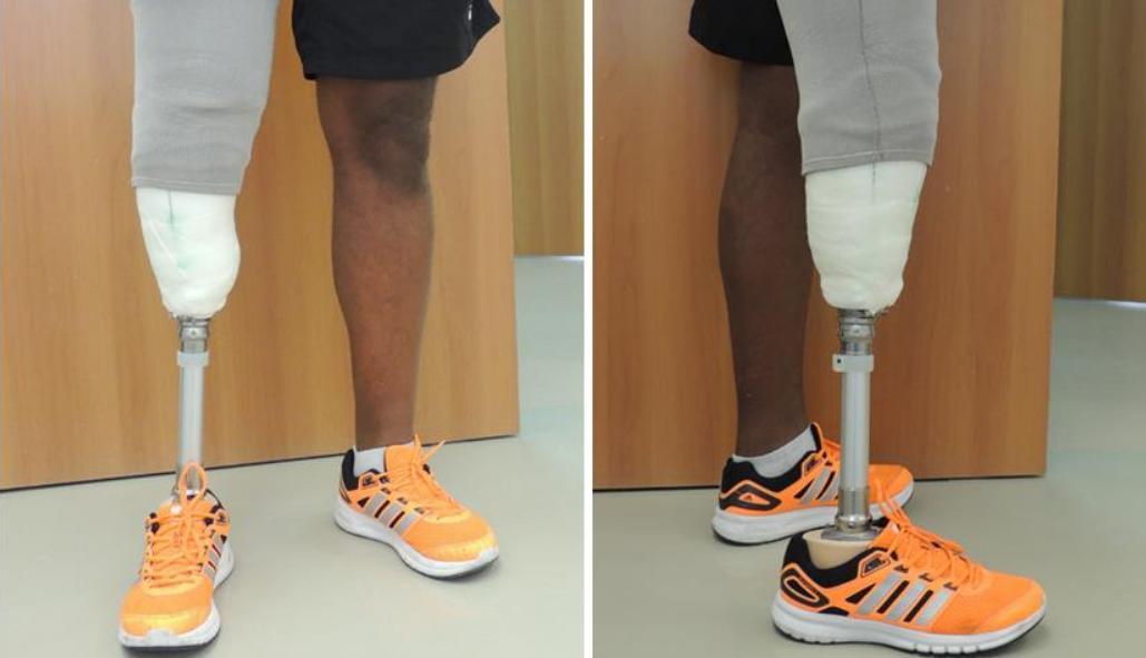 Researchers Create Perfect Fitting 3d Printed Transtibial Leg Socket