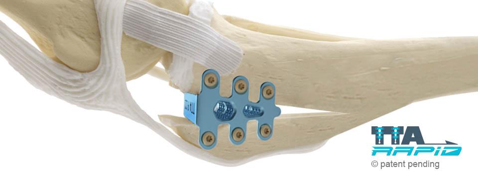 Slider bone+implant