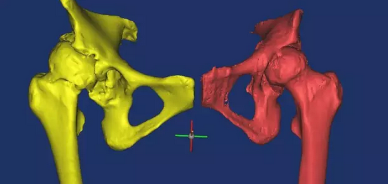 This picture shows the preoperative three-dimensional reconstruction