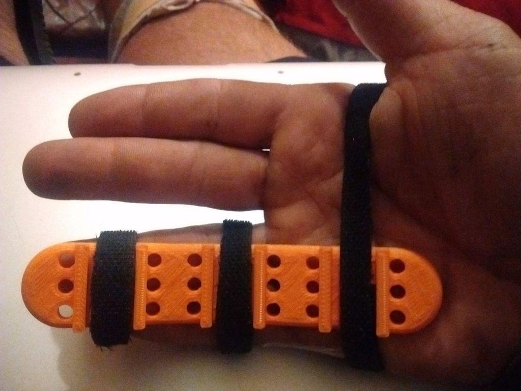 San Francisco Maker 3D Prints a Better, Custom-Fitted Splint