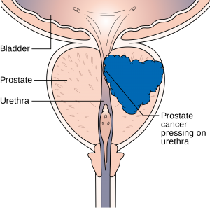 Diagram_showing_prostate_cancer_pressing_on_the_urethra_CRUK_182
