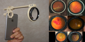Retinal Imaging Made Easier With 3D Printed Adaptor