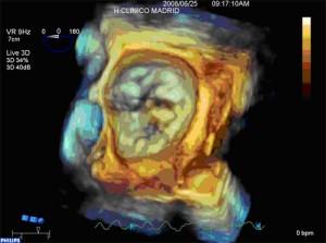 Mitral valve prolapse scan collected using 3DTEE imaging.