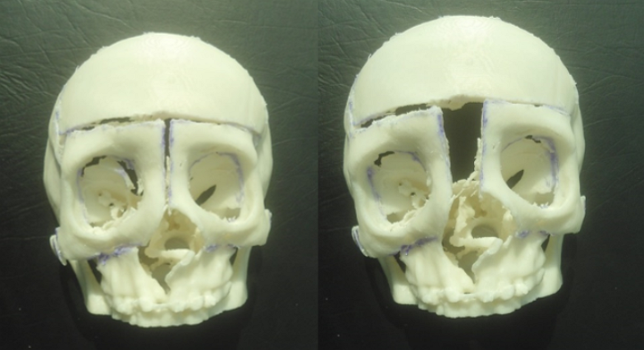 Osteo3d-3d-printing-healthcare-medical-models-Facial-Bipartition-Box-Osteotomy-ClinicalCase2.jpg