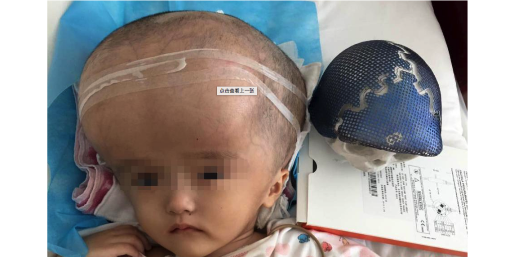 3-Year-Old with Extremely Large Head Receives Groundbreaking Skull