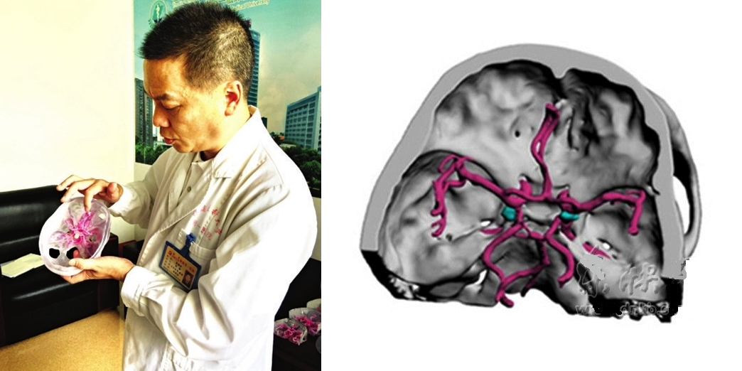 3D Printing Makes a Complex Brain Surgery Possible, Saving The Life of a