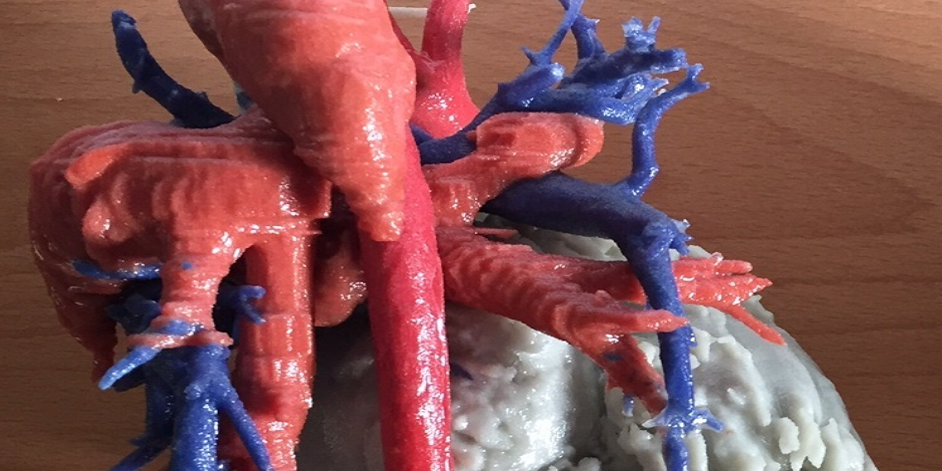 Heart Transplant Surgery Performed With Help of Color Coded 3D Printed Model