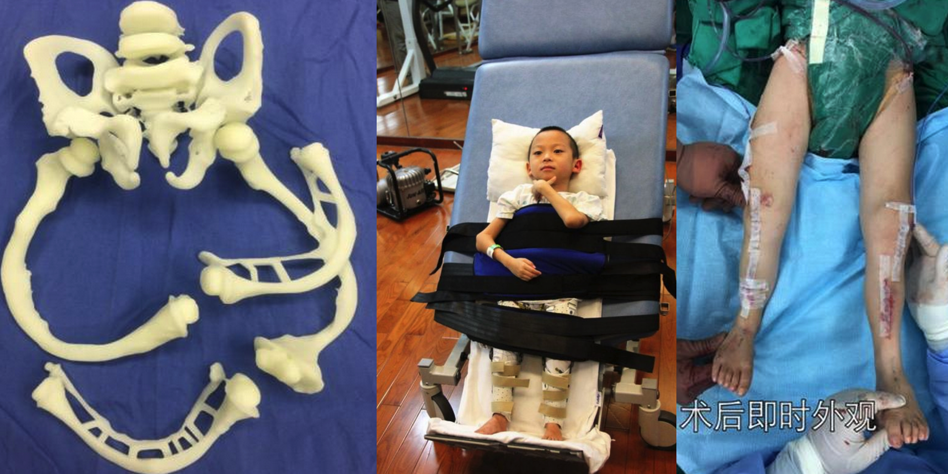 Boy With Severely Deformed ‘Porcelain Legs’ Sees His Life Saved by 3D Printing