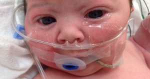 3D Printed Jaw Aids Surgeons Performing Operation on Infant