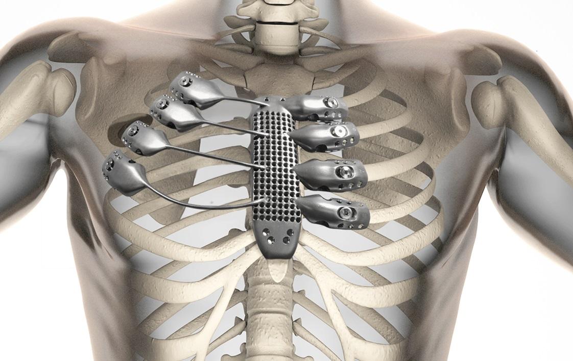 3D Printing Gives Cancer Patient New Ribs and Sternum in First-of-Its
