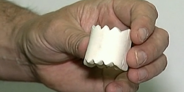 Croatian Cancer Patient Receives First All Acrylic 3D Printed Vertebra with Great Success
