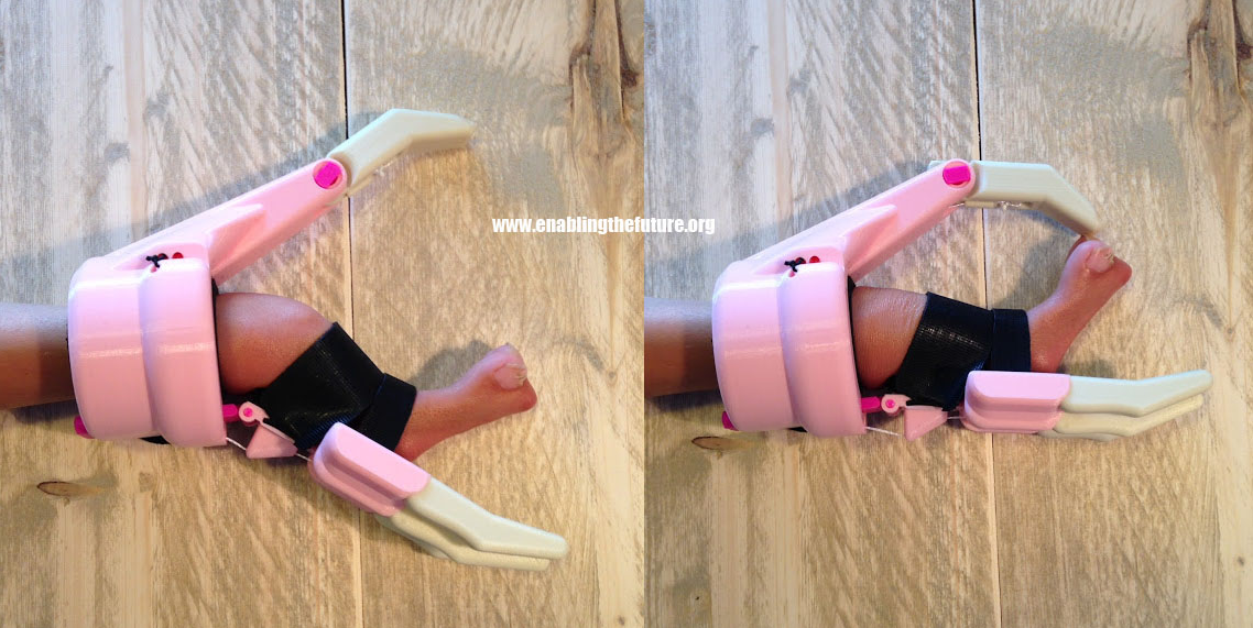 Yu-Lia Gains a 3D Printed Hand Prosthetic; e-NABLE Volunteer Successfully Takes on Challenging Pinching Design