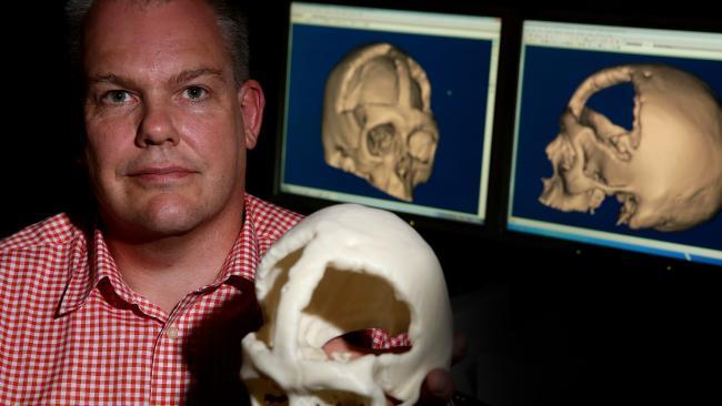 Royal Perth Hospital biomedical engineer Dr Alan Kop holding skull with damage