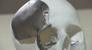 3D printed titanium medical implant.