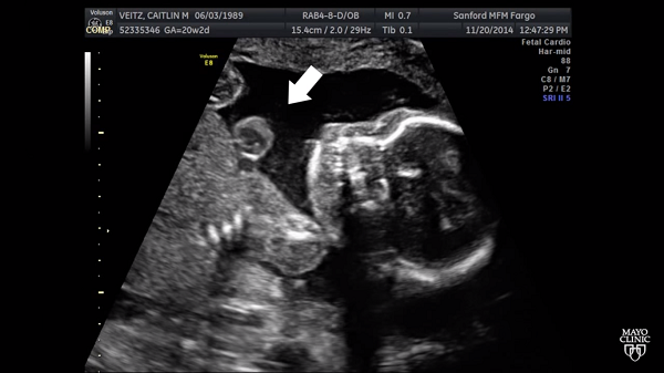 An-ultrasound-shows-Kieran-heart-outside-her-chest