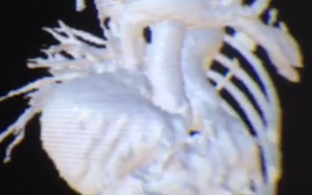 Doctors Used Virtual Reality with Google Cardboard and Sketchfab to Save a Baby’s Life