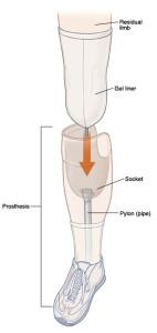 A standard socket-type leg prosthetic.