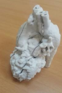 3D printing model of heart - Nikaidoh Procedure