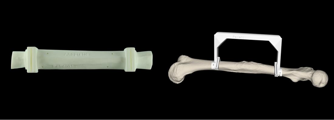 3D printed femur resection guideline.
