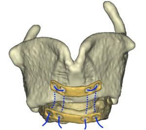 Reconstructed postoperative larynx